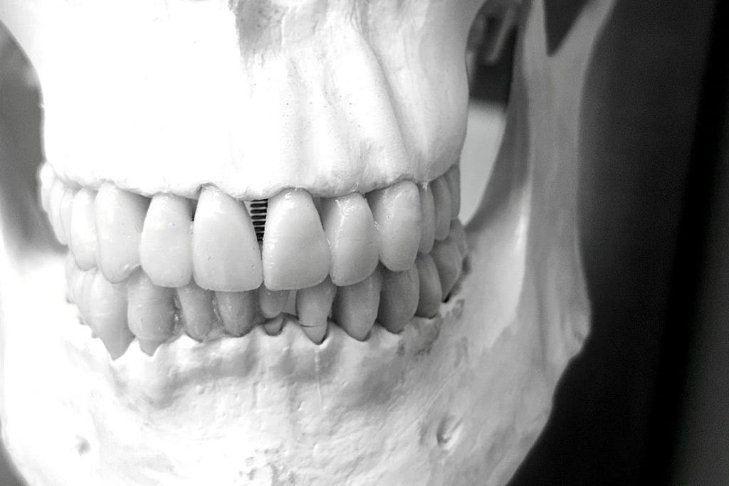 해외 치과 임플란트 시술 이미지