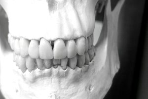 해외 치과 임플란트 시술 이미지