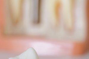 해외 치과 임플란트 시술 이미지