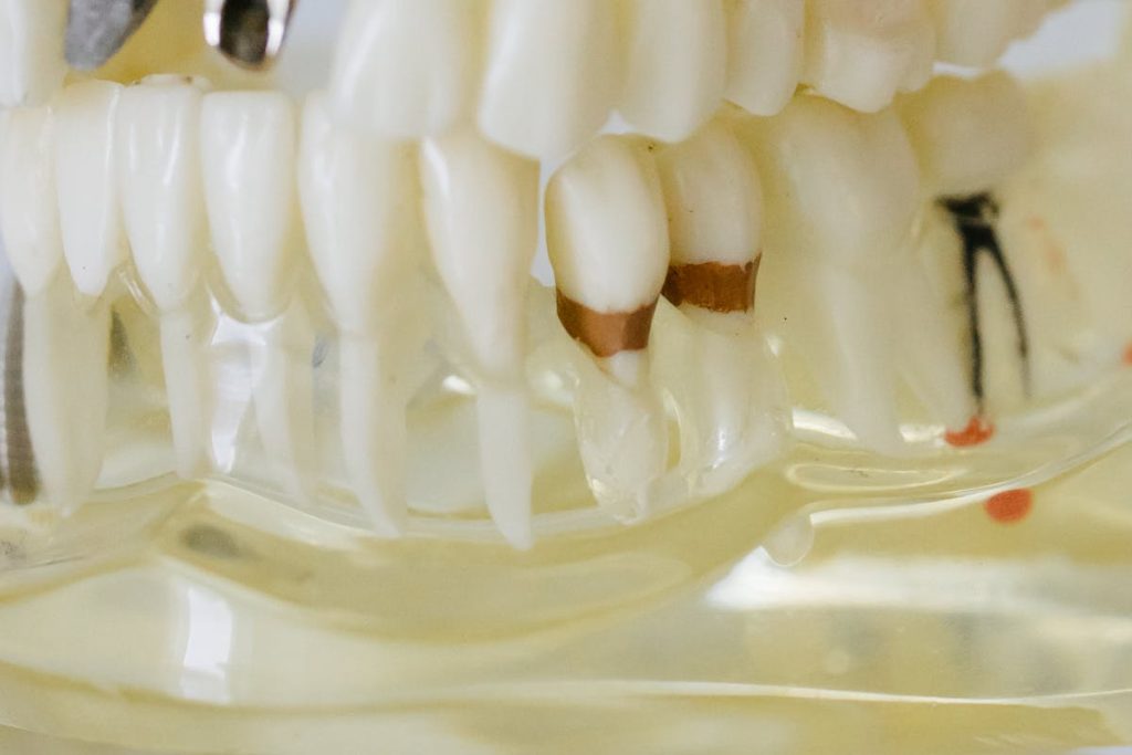 해외 치과 임플란트 시술 이미지