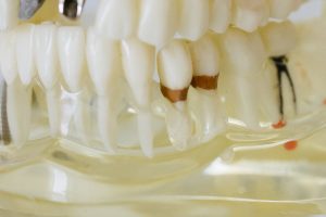 해외 치과 임플란트 시술 이미지