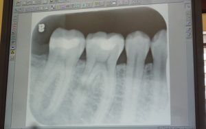 대전임플란트 상담과 실제 치과 진료 사진 063